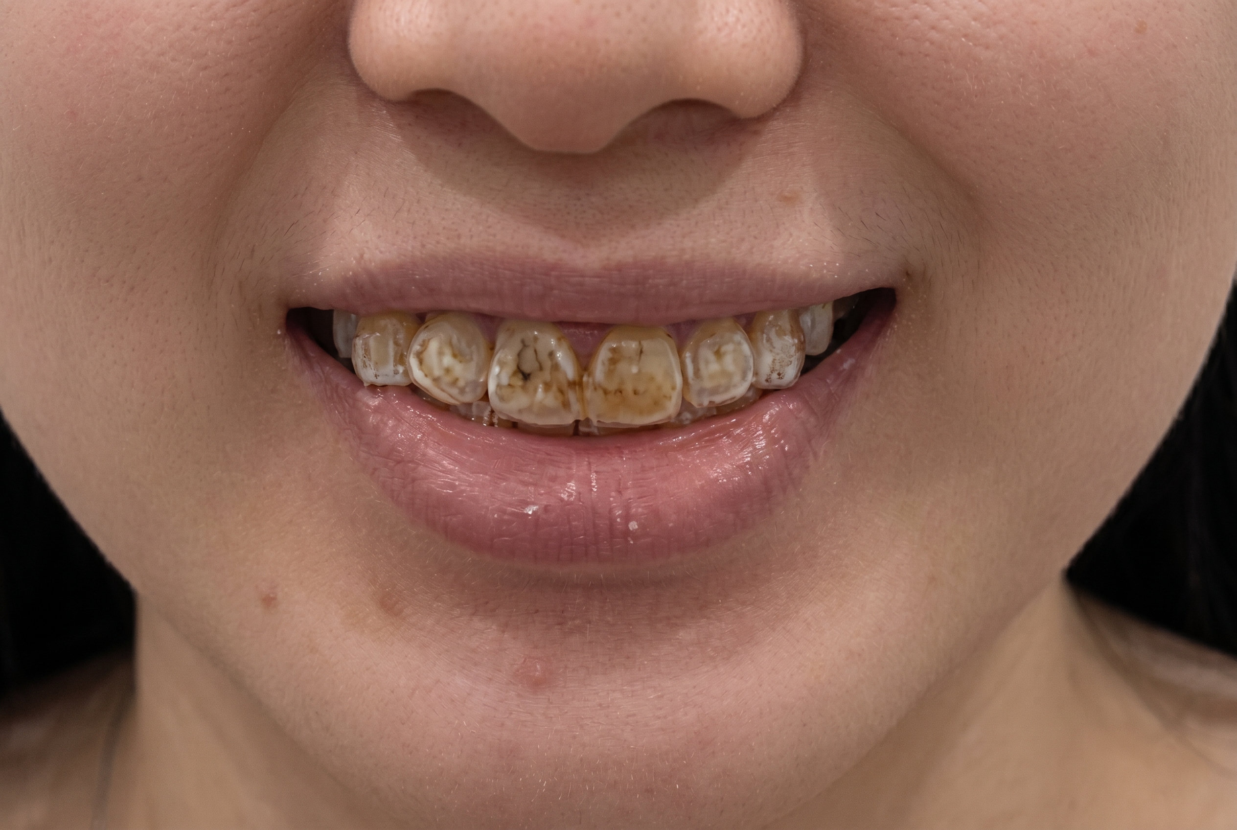 Smile Makeover - Before
